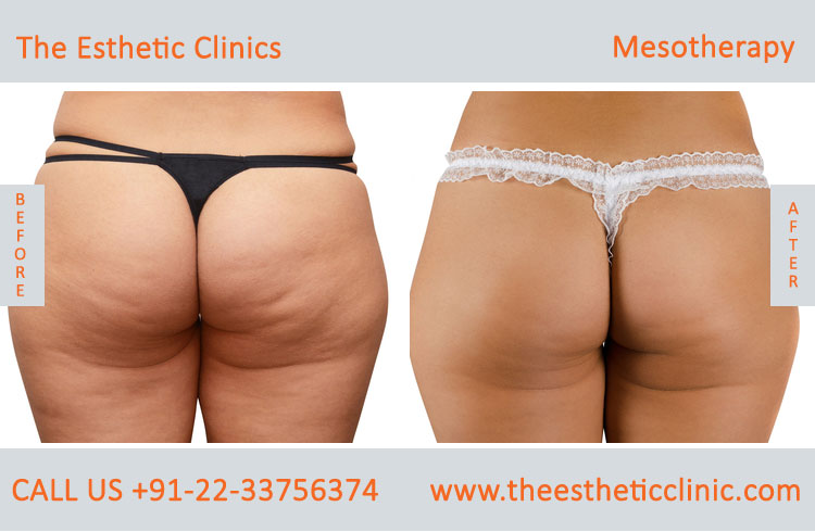 Mesotherapy for Hair Loss Face Skin Treatment before after photos in mumbai india (5)